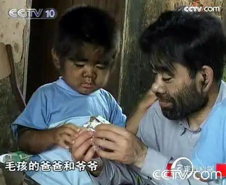 [视频]揭双胞胎兄弟一人身上遗传长毛之谜