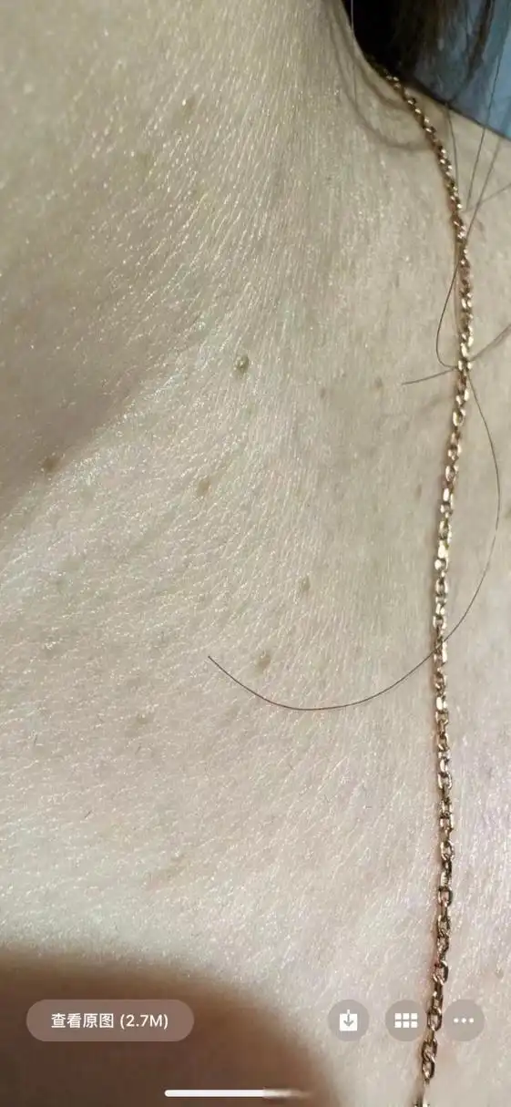 健康美好生活计划# 高主任 脖子上这个是扁平疣吗?