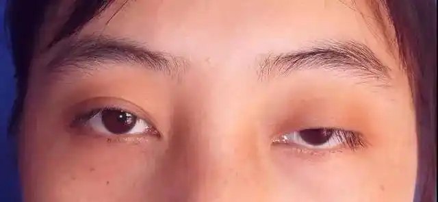 眼睑下垂的原因