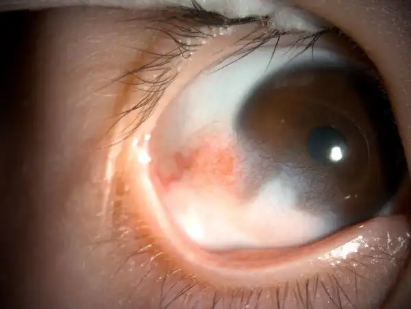 8岁发现弱视能自愈吗(眼珠上长了个疙瘩)(1)