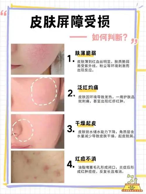 纯干货皮肤屏障受损硬核修复全在这篇