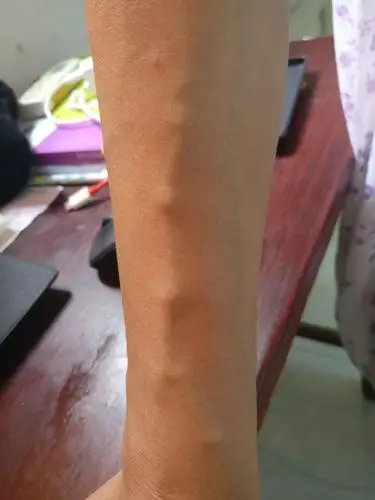 请问手臂上的血管这样是怎么回事?