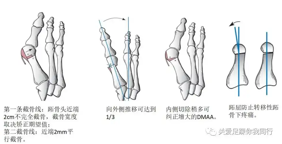拇外翻专题系列之六手术技巧