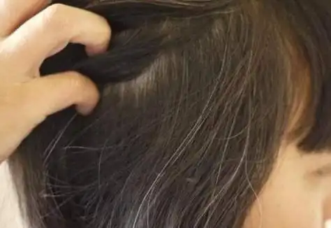 白头发突然增多可能和年龄无关缺少这3种营养可能会长白头发