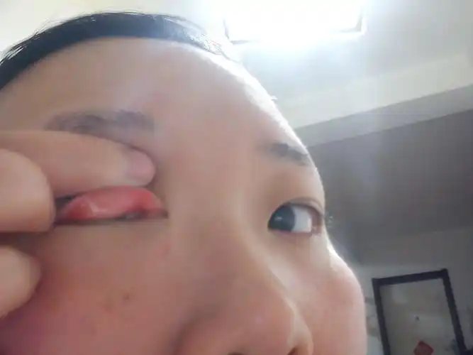 之前带了一天的隐形眼镜,觉得右眼上部疼,之后拿出来翻开眼皮看上眼睑