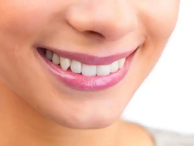 女生虎牙矫正,脸型悄然变美?医生告诉你真相!