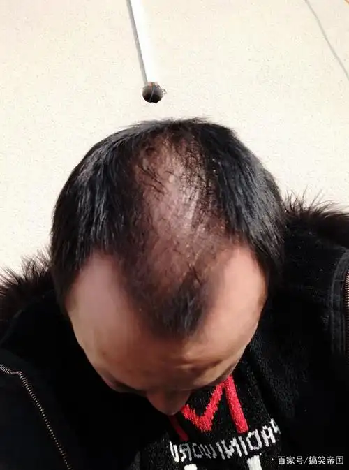 曾经一头秀发的小伙,如何在十年成秃顶大叔?又怎么5个月逆转?