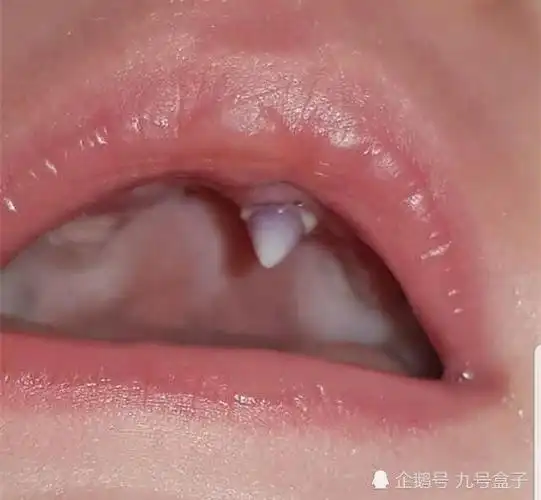 以为变吸血鬼了11周宝宝一夜之间长出一颗锋利尖牙吓坏母亲