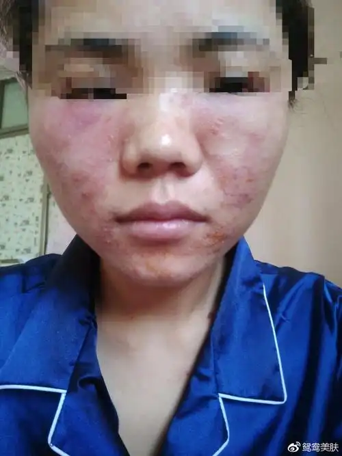 护肤品过敏什么症状?