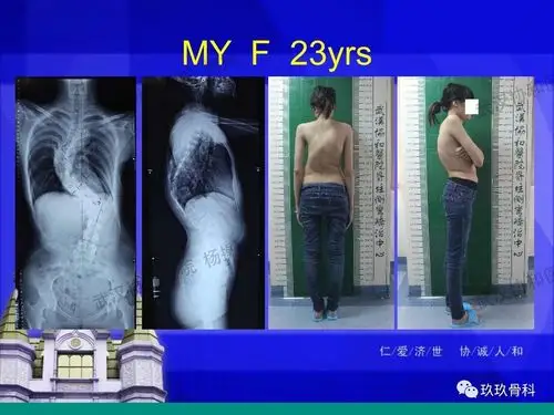 历历在目!马凡氏综合征"百折不回"-第2张图片-风筝网