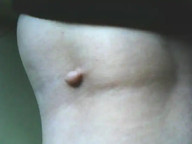 两年前腿弯的地方突然长了一个豌豆大的肉痣,和皮