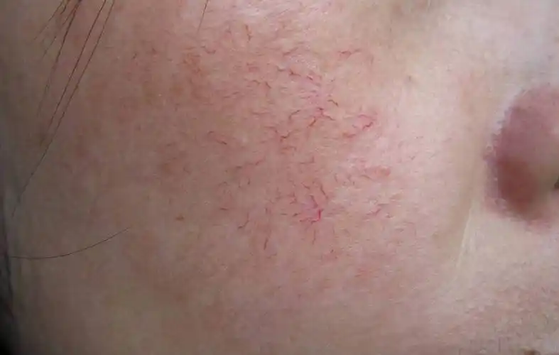 原创脸上有红血丝的女生必看教你几招摆脱红血丝不做大红脸