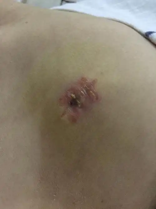 我是采用手术切除点的痣 现在拆线已经四天 发现伤口处有一块黑色的