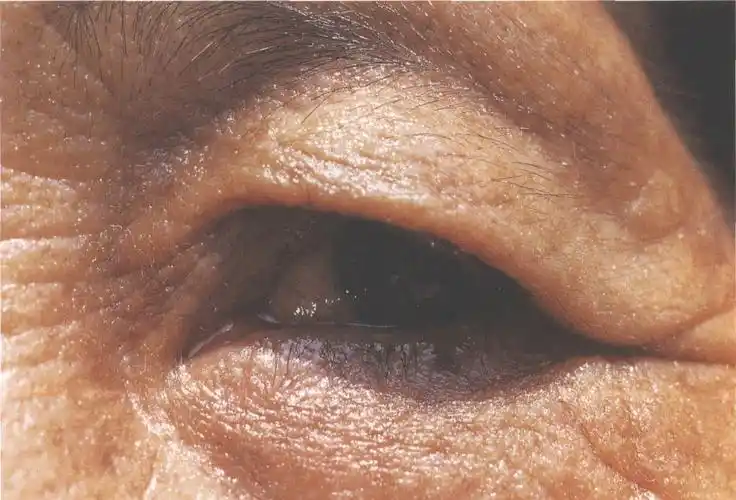 (图) 老年性上眼睑松弛症和睑裂狭小