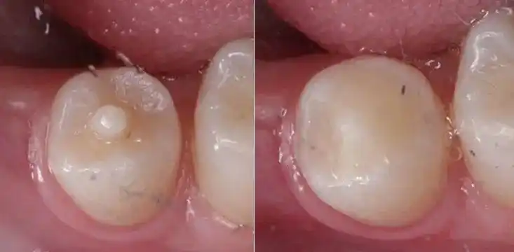 孩子新换的后牙中间多了一个尖_腾讯新闻