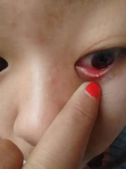 下眼皮长出这个是因为什么