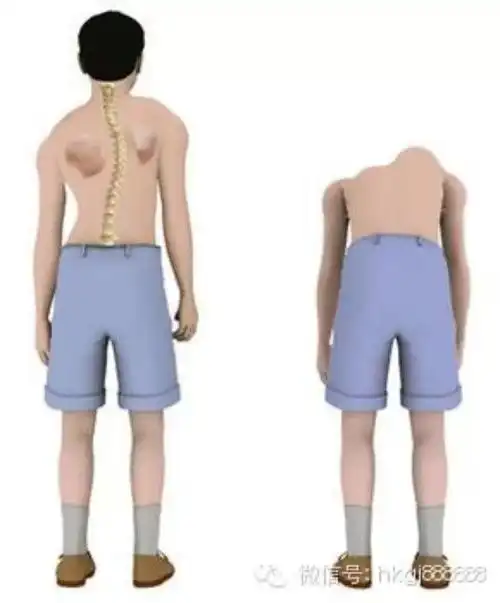 迎六一儿童节,送健康大礼包——记小米粒中队脊柱侧弯筛查爱心活动