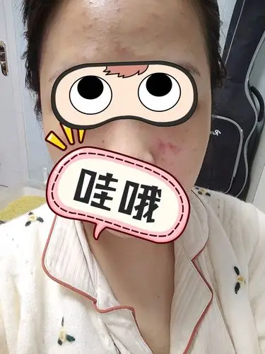 果酸换肤后第一天,脸颊皮肤比较薄,红了一片,这是正常的嘛