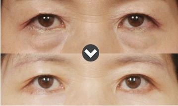 下眼睑整形前后对比