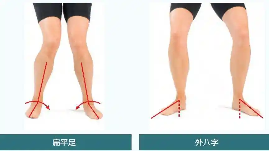 走路外八字什么原因