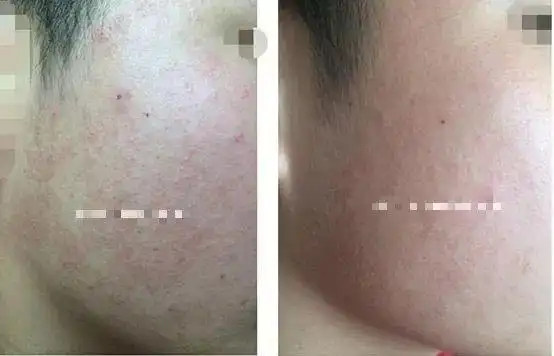 果酸换肤术后不懂护理那你就相当于白做了