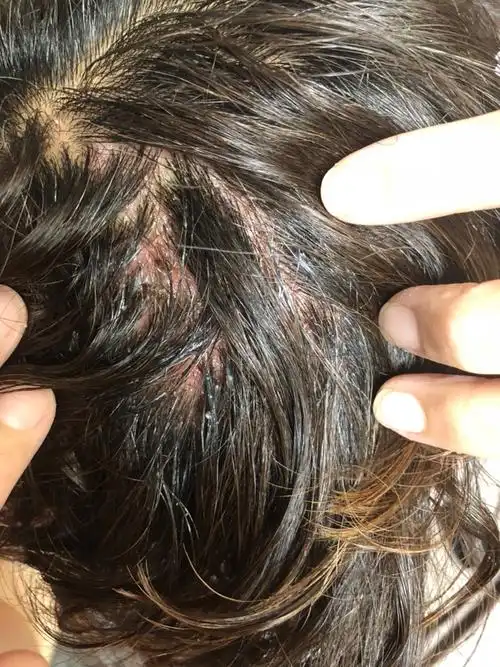 吃靶向药,头皮成这样子了