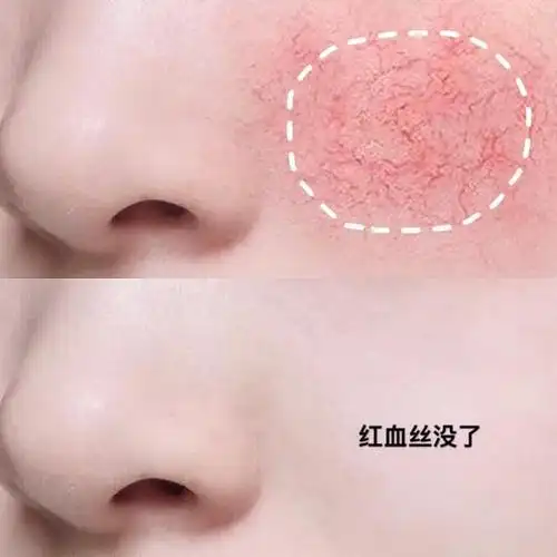面部皮肤,但是还是会遇到各种各样的问题,比如自己的脸上出现红血丝