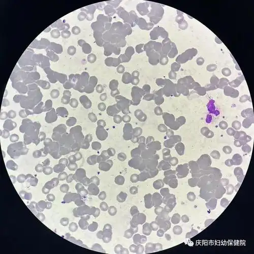 一例血常规中发现的红细胞冷凝集