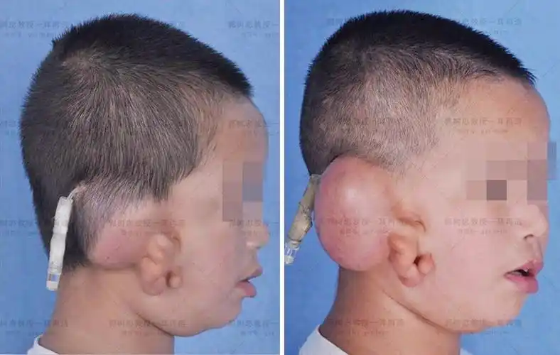 小耳畸形科普文章:我是如何造耳朵的(五) 激光脱毛