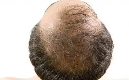 男性头顶中央脱发是什么原因