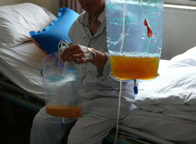 甲状腺癌颈淋巴结清扫术的一个罕见并发症:双侧乳糜胸 - 好大夫在线