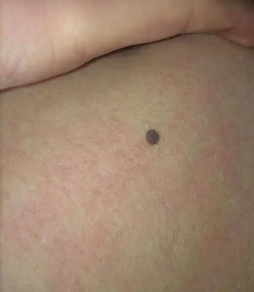请问我肚子上的这颗痣最近有点痒,会不会是得了黑色素瘤?