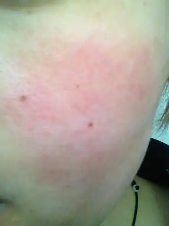 脸过敏后特别干 紧绷 擦完水和乳 一会又感觉紧绷 怎么办啊 烦死了_百