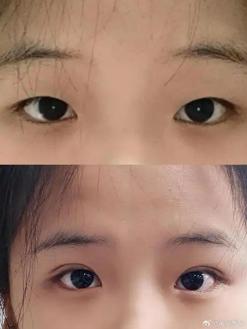 一个月过去了,你的双眼皮是否已经完全恢复了呢?
