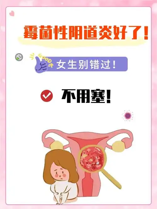 生活中很多女生会感染霉菌性阴道炎,这是因为女生的抵抗力较弱,由于