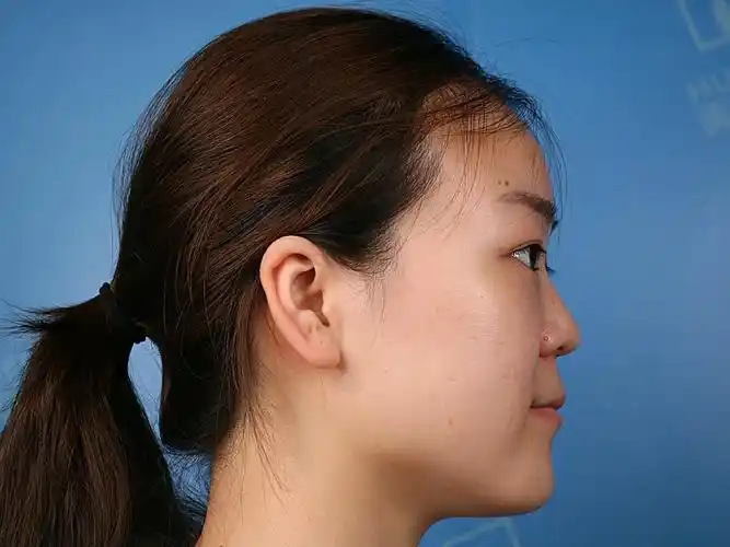 侧面脸扁平扁平凹陷脸侧面扁平女生图片照凹陷侧面侧面脸看起来扁平