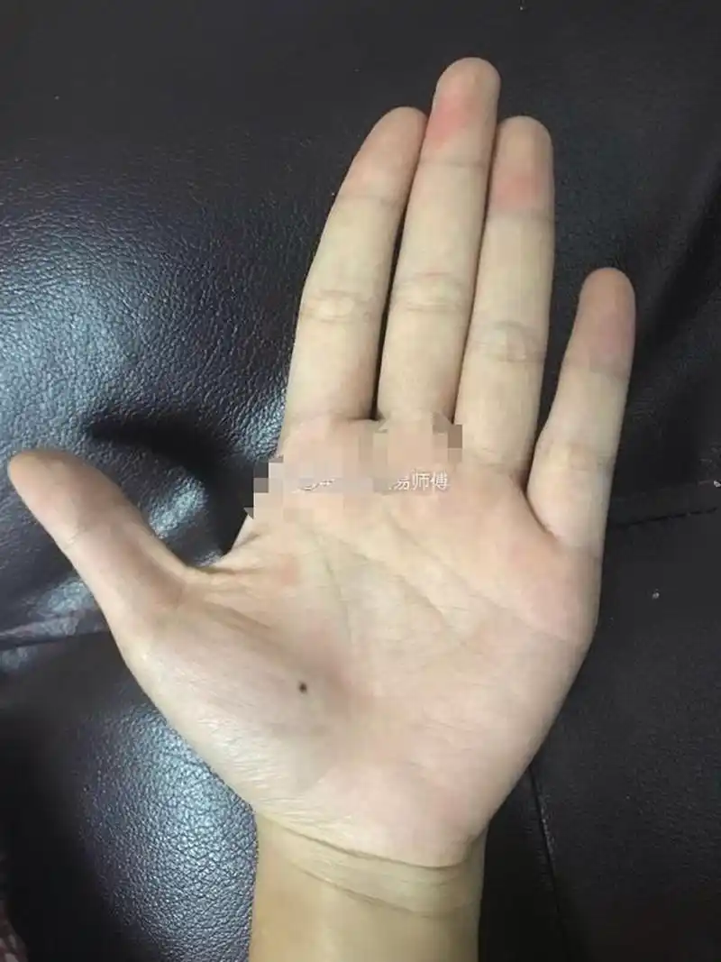 金星丘有痣,说明早年家境较好,或父母保护的比较好,少年时期生活的