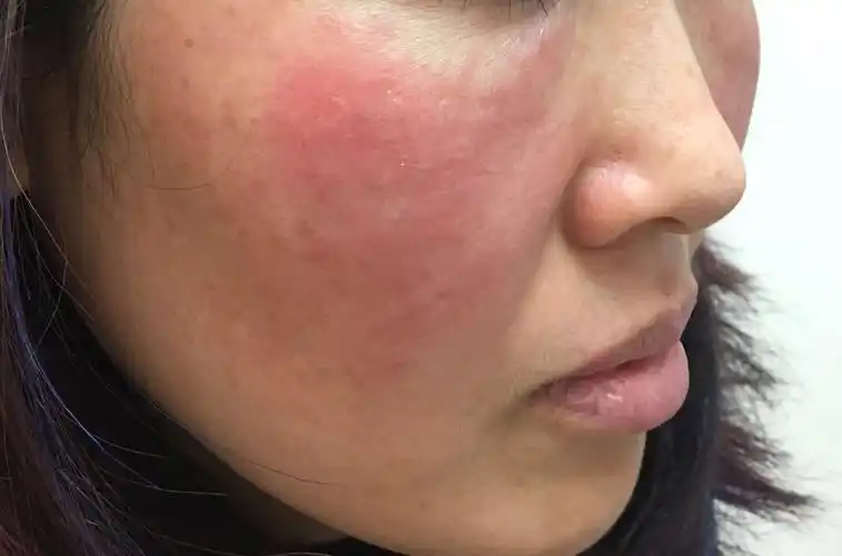 "敏感肌肤"谨防酒糟鼻 - 好大夫在线