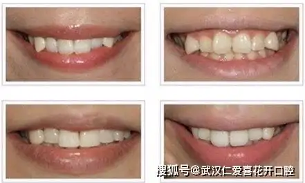 龅牙,虎牙是否真的"美"?解析牙齿数目以及对美观的影响