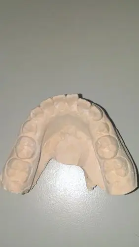 上下颌石膏模型全图下颌前牙轻度拥挤,左边尖牙正在萌出上颌侧切牙