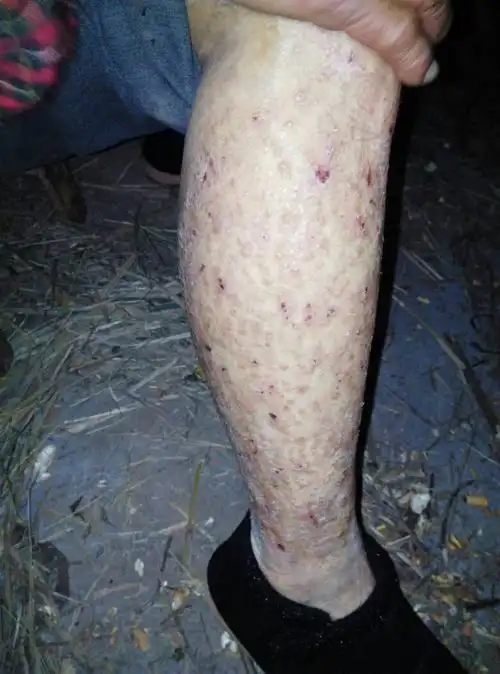 数:1获赞数:1lv1 擅长:暂未定制 向ta提问私信ta  展开全部 那是癣  1