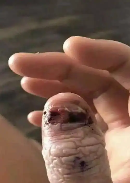 娃又把指甲啃秃了没事就啃怎么破