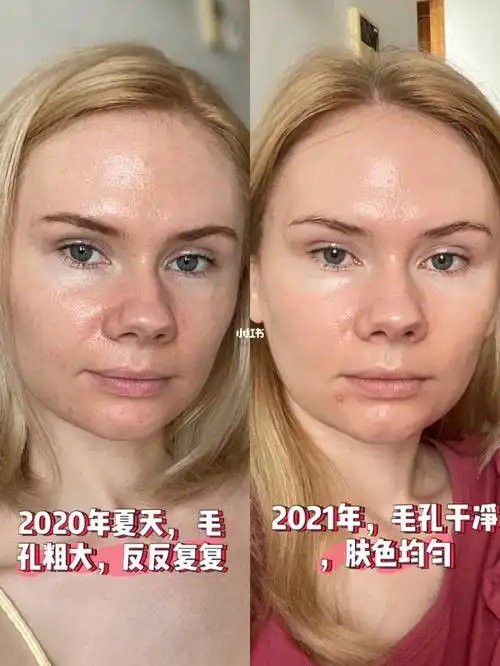 照片对比|皮肤改善很多_a醇_敷面膜_毛孔_痘痘_护肤_夏天去哪玩