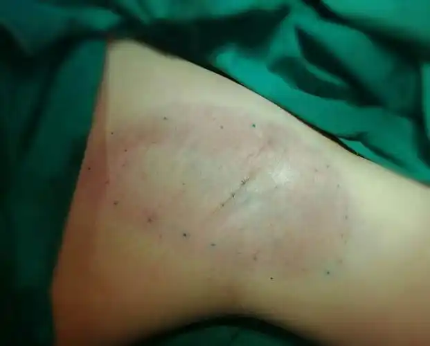 腋臭的微创手术治疗_腋臭_治疗方式_日常注意事项 - 好大夫在线