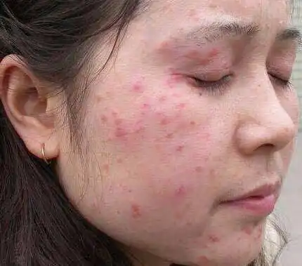 皮肤病的种类繁多,病因也复杂,到底该如何区分辨别? 第一,颜面部再