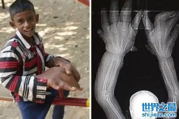 世界上最大的手指食指长度高达30厘米