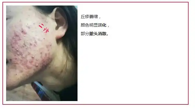 成都秉正堂中医馆罗阳治疗面部痤疮