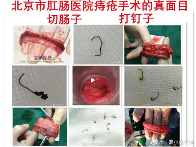 患者痔疮手术后发现直肠少了一截,多了32颗金属钉!