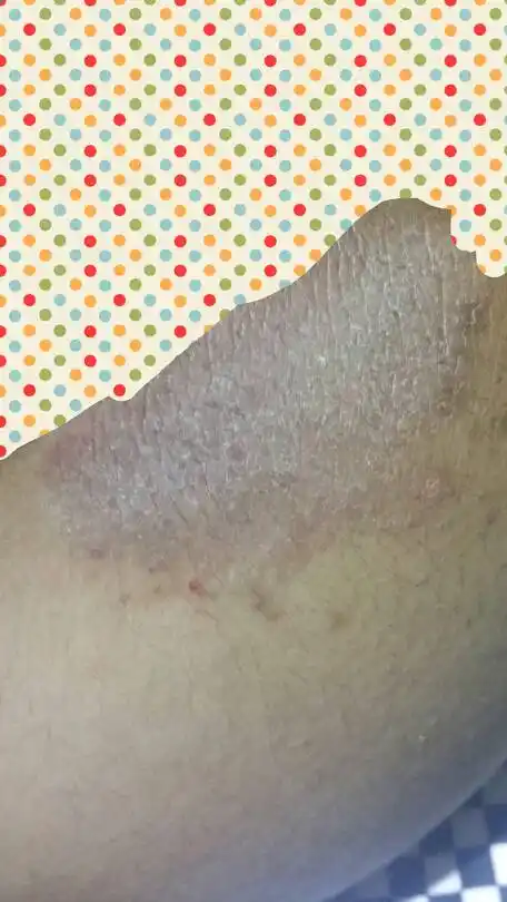 我儿子的屁股不知道得了什么皮肤病,他说有时候很痒,应该用点什么药?