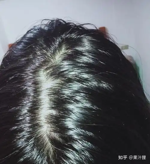 头发出油多头屑多脱发怎么去化工专业男朋友帮你排除万难